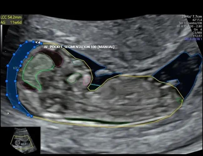 Fetal Ultrasound AI